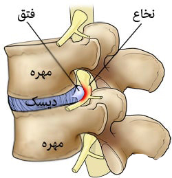 بیماری فتق دیسک کمر چگونه رخ می‌دهد؟