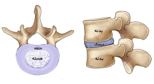 دیسک کمر چیست و کجا قرار دارد