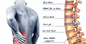 نشانه های کمر درد التهابی چیست؟