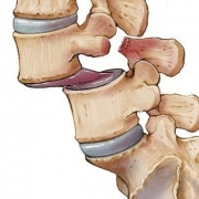 هزینه جراحی سرخوردگی مهره کمر