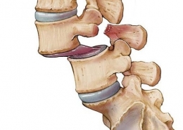 هزینه جراحی سرخوردگی مهره کمر