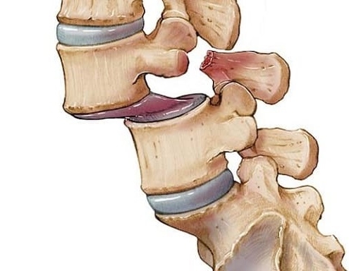 هزینه جراحی سرخوردگی مهره کمر
