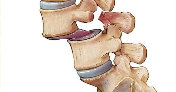 هزینه جراحی سرخوردگی مهره کمر