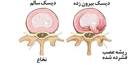 دیسک کمر