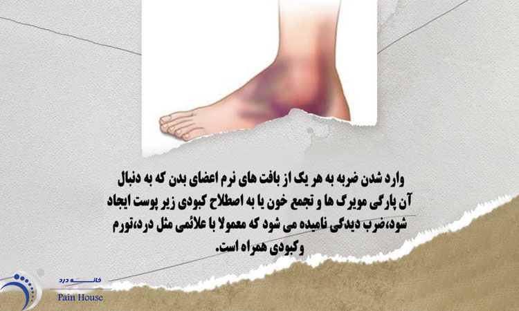 کبودی مچ پا