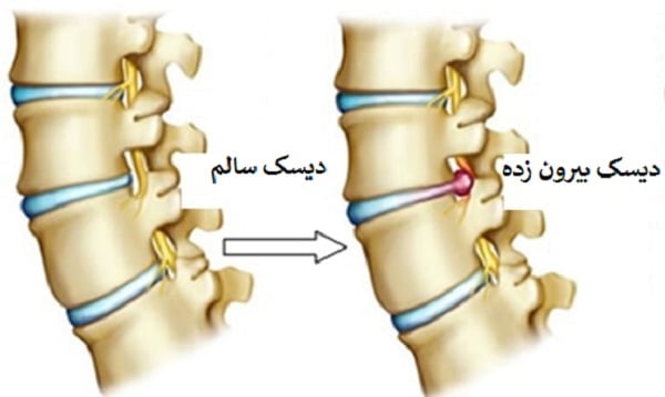 نشانه های دیسک کمر