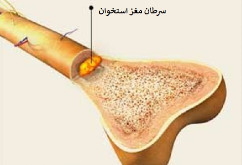 سرطان معز استخوان 