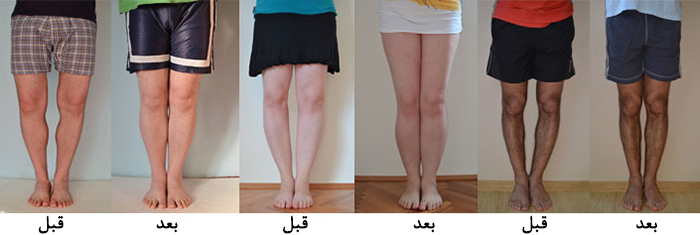 تجربیات عمل زانو پرانتزی
