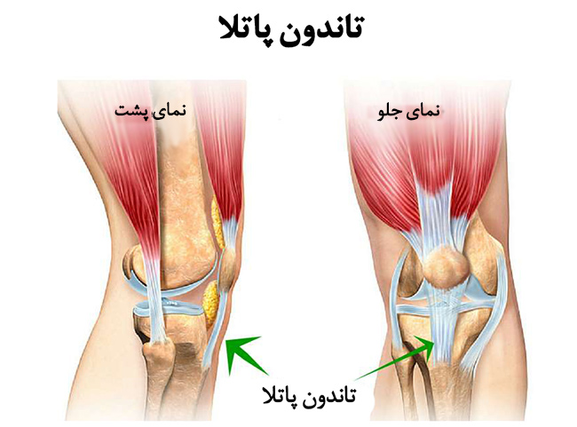 التهاب تاندون