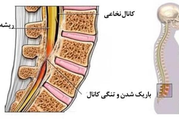 عکس تنگی کانال نخاعی