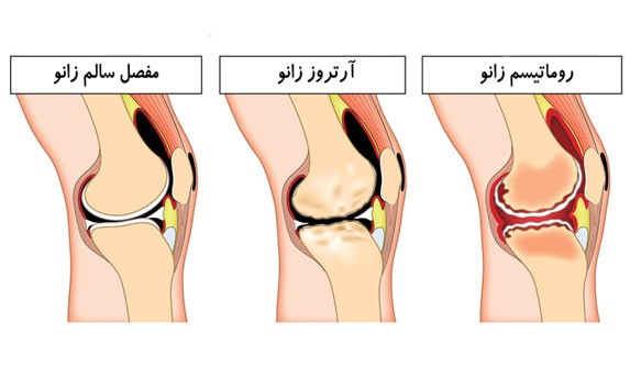عکس زانوی مبتلا به آرتروز