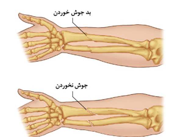 نشانه های جوش خوردن استخوان