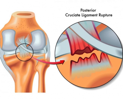 درمان کشیدگی و پارگی رباط زانو