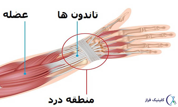 تاندون مچ دست