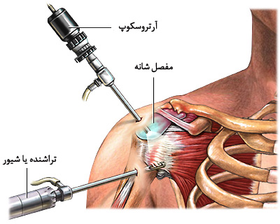 ترمیم تاندون شانه