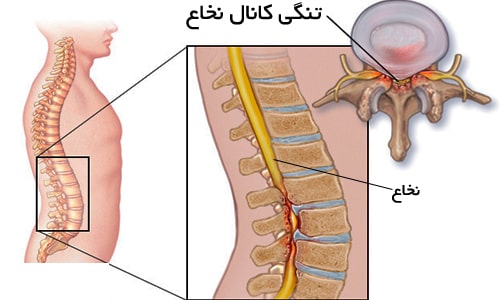 عکس تنگی کانال نخاعی