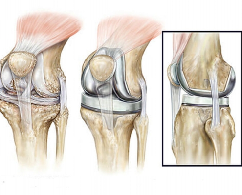 دلیل جراحی تعویض مجدد مفصل زانو