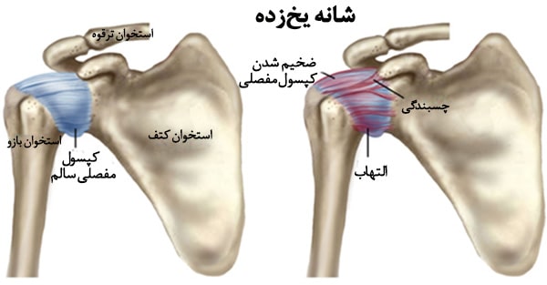 شانه یخ زده