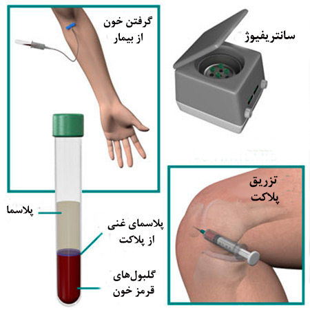 عکس مراحل پی آر پی