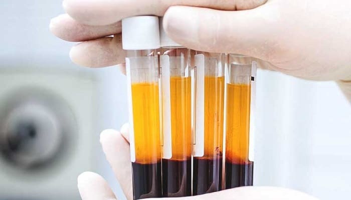 تزریق PRP