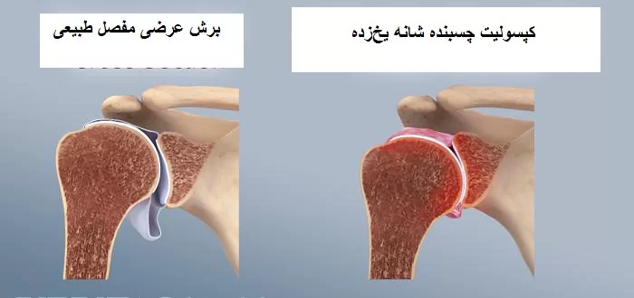 شانه منجمد
