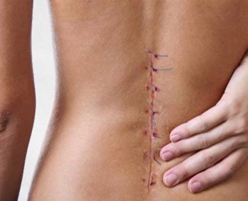 عوارض جراحی ستون فقرات