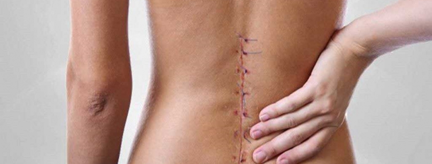 عوارض جراحی ستون فقرات