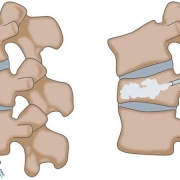 تزریق سیمان به مهره کمر