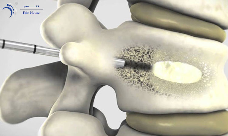 عوارض تزریق سیمان در ستون فقرات