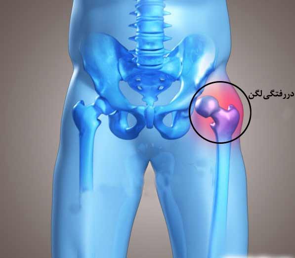 عکس در رفتگی لگن