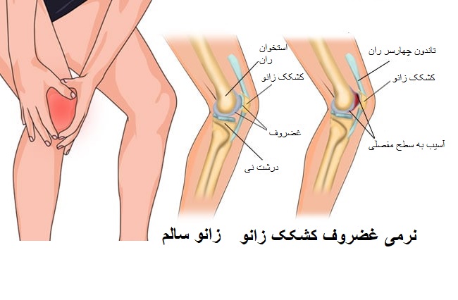 عکس نرمی کشکک زانو
