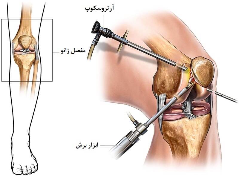 مدت زمان عمل آرتروسکوپی زانو