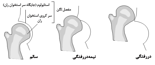 عکس در رفتگی لگن