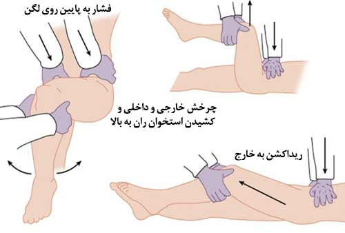 عکس جا انداختن لگن و مفصل هیپ
