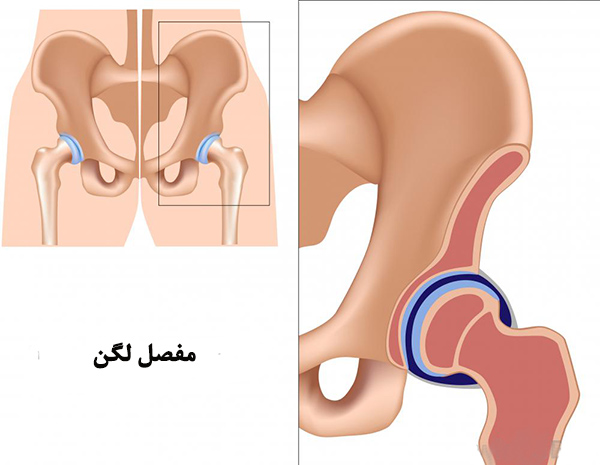 جا انداختن دررفتگی لگن