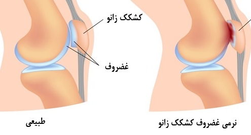 نرمی کشکک زانو