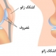 نرمی کشکک زانو