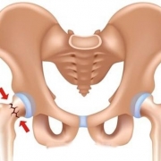 دررفتگی لگن