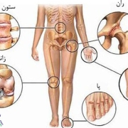 آرتروز کمر و دست و پا