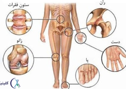 آرتروز کمر و دست و پا