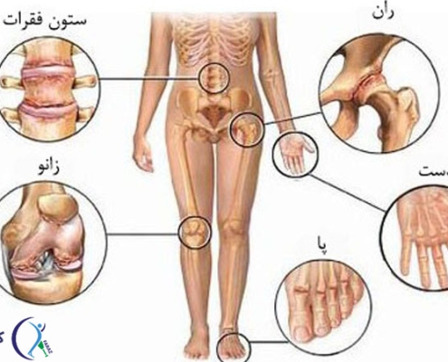 آرتروز کمر و دست و پا