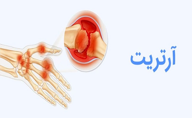 آرتریت چیست