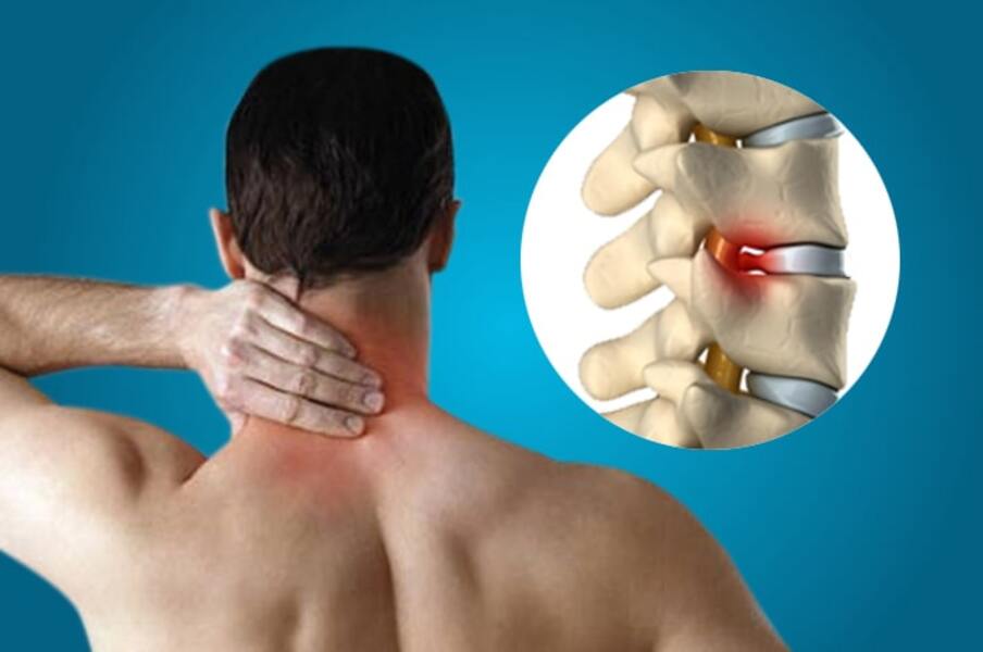 شایع ترین علائم دیسک گردن