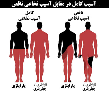 انواع ضایعه نخاعی