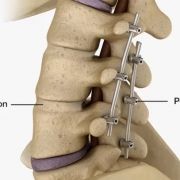 جراحی فیوژن کمر و ستون فقرات