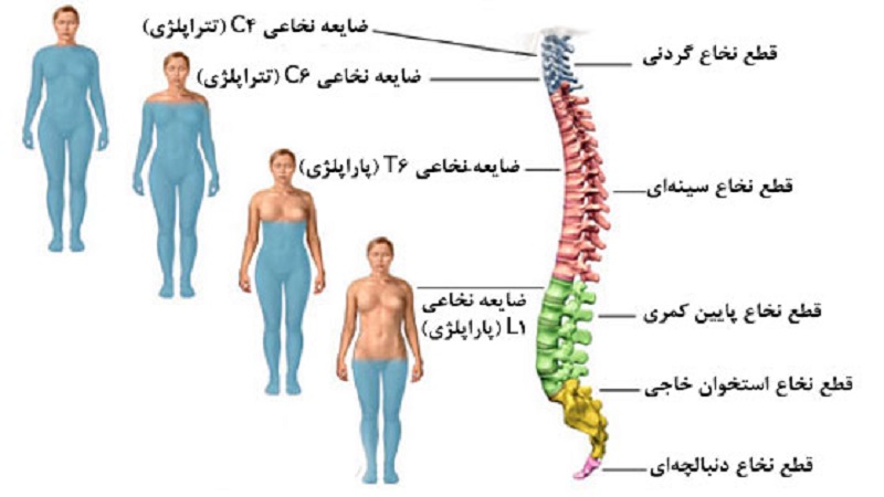 ضایعه نخاعی