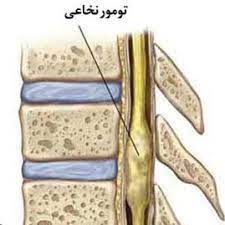 عکس تومور نخاعی