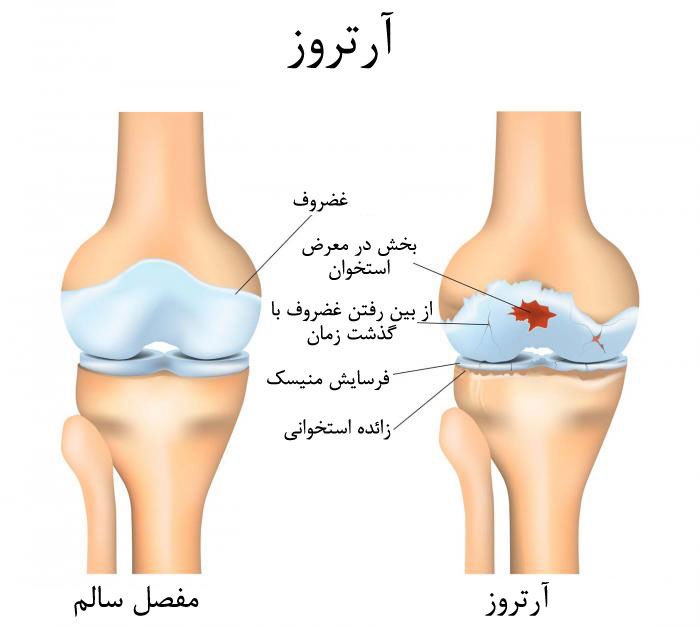 عکس آرتروز
