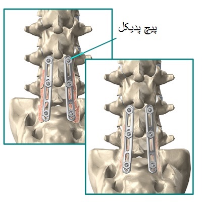 عکس پیچ و مهره در کمر