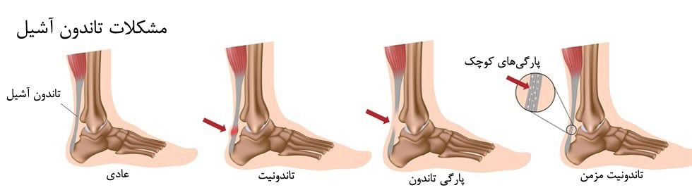 درجات پارگی تاندون پا